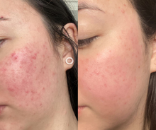Load image into Gallery viewer, Rosacea Recovery Set