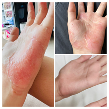 Load image into Gallery viewer, Body Eczema & Psoriasis Relief Kits