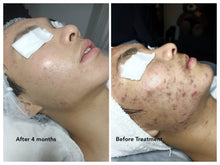 Load image into Gallery viewer, AcneFree Facial 90mins - Sharyln & Co