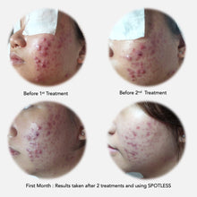 Load image into Gallery viewer, KYLN SPOTLESS Acne Serum. 20ml. - Sharyln & Co